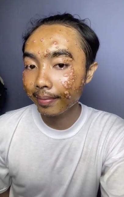 TikToker’s unwashed thrifted clothes lead to viral skin infection