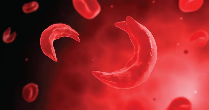 Nigeria faces 150,000 new sickle cell battles each year – Harvard expert