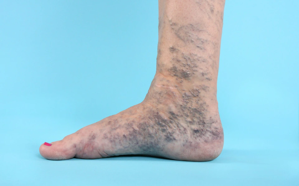 Swollen ankles and blood clots: How unhealthy veins kill you…