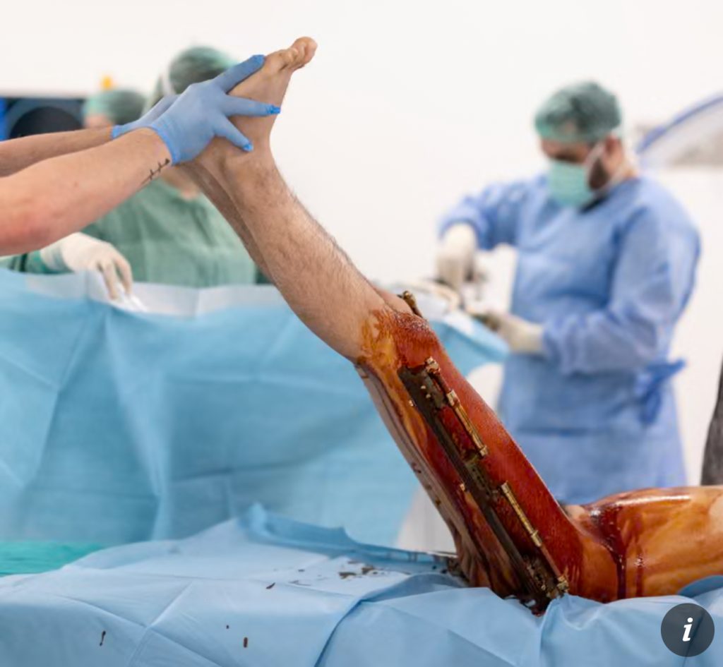 “Time to grow”: Patient endures agony to add inches through bone-breaking procedure