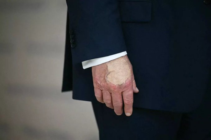 Concerns rise over Trump’s fitness after makeup-caked hand appearance