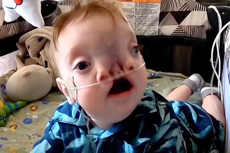 Baby with rare condition faces first surgery to reunite split face