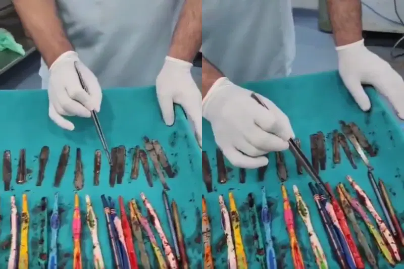 Doctors extract 29 Spoons and 19 toothbrushes from stomach