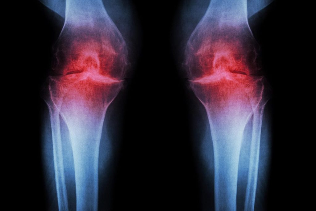 Scientists discover injection that regenerates knee cartilage and prevents arthritis