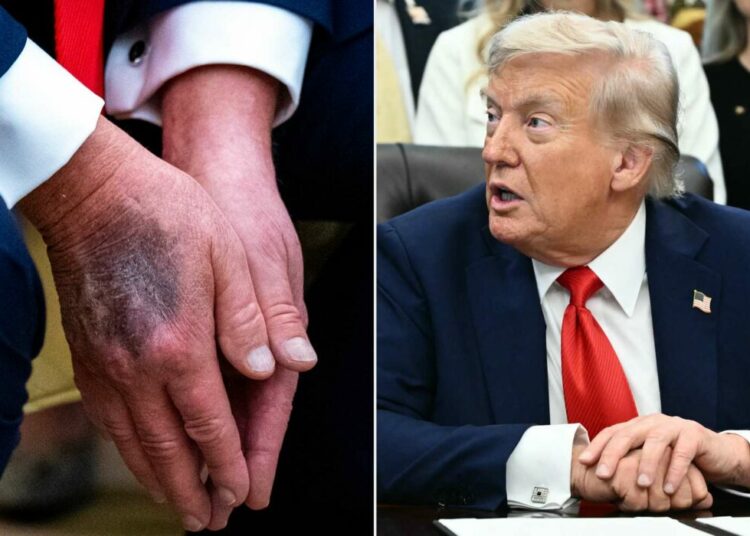 Trump admits taking excess aspirin behind visible hand bruises Trump admits taking excess aspirin behind visible hand bruises